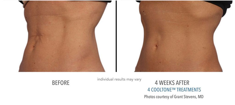 Before and after 4 CoolTone treatments to woman's abdomen, at Always Beautiful.