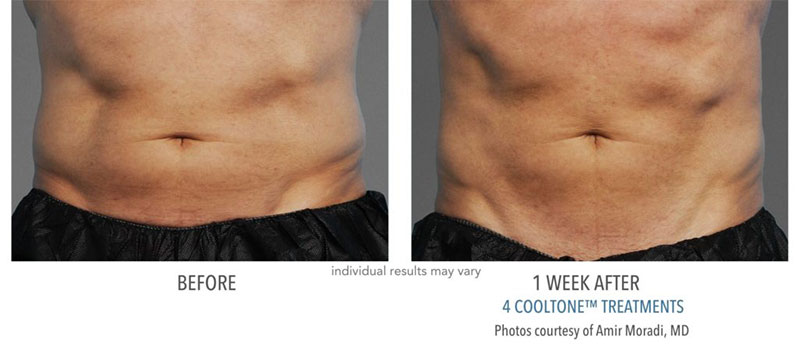 Before and after results to man's abdomen from CoolTone treatment at Always Beautiful