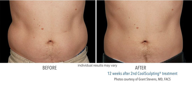 Man's before and after results from CoolSculpting treatment at Always Beautiful.