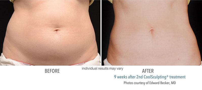 Woman's before and after results to abdomen from CoolSculpting treatment at Always Beautiful. 