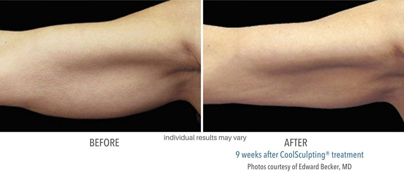 Woman's before and after results of CoolSculpting treatment from Always Beautiful to treat under arms. 