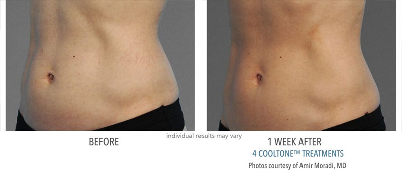 Before and after results of woman's abdomen from CoolTone treatments at Always Beautiful.