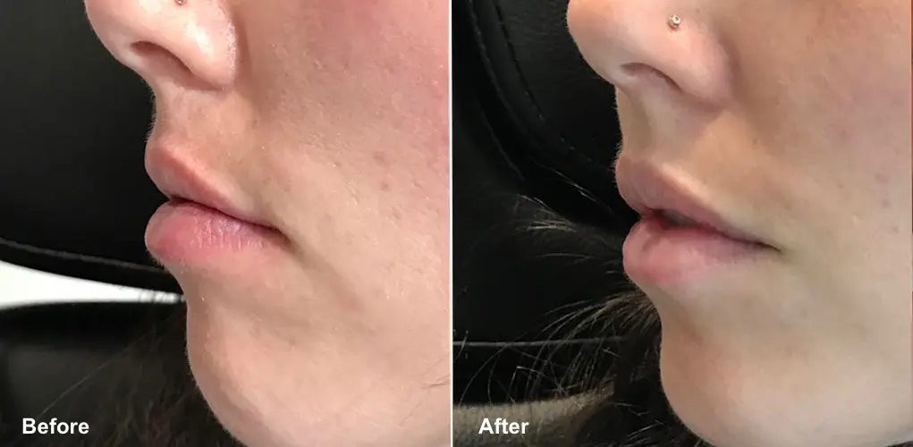 Juvederm before and after, lips done at always beautiful.