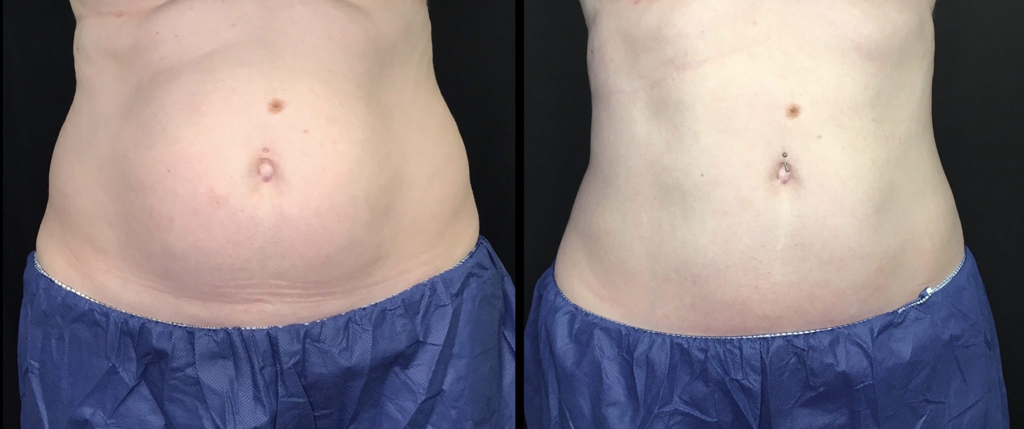 CoolSculpting In Aurora and Denver