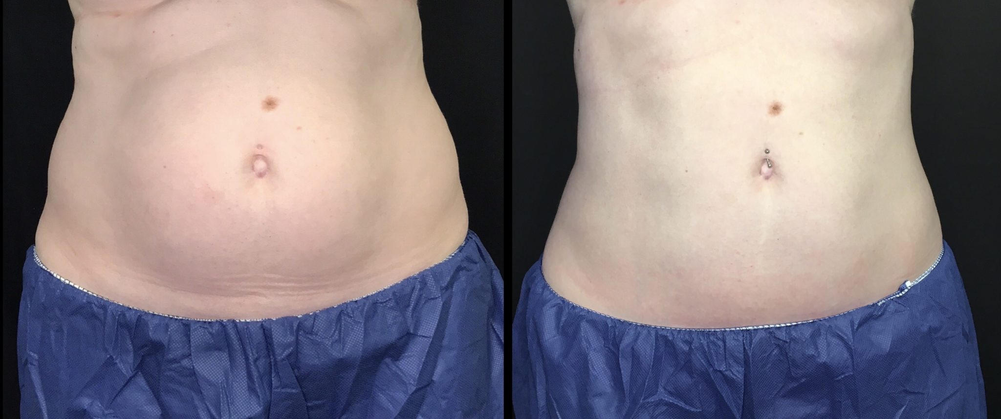 CoolSculpting on the abdomen