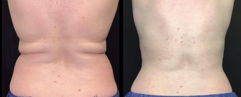 Fat Freezing Aurora CO