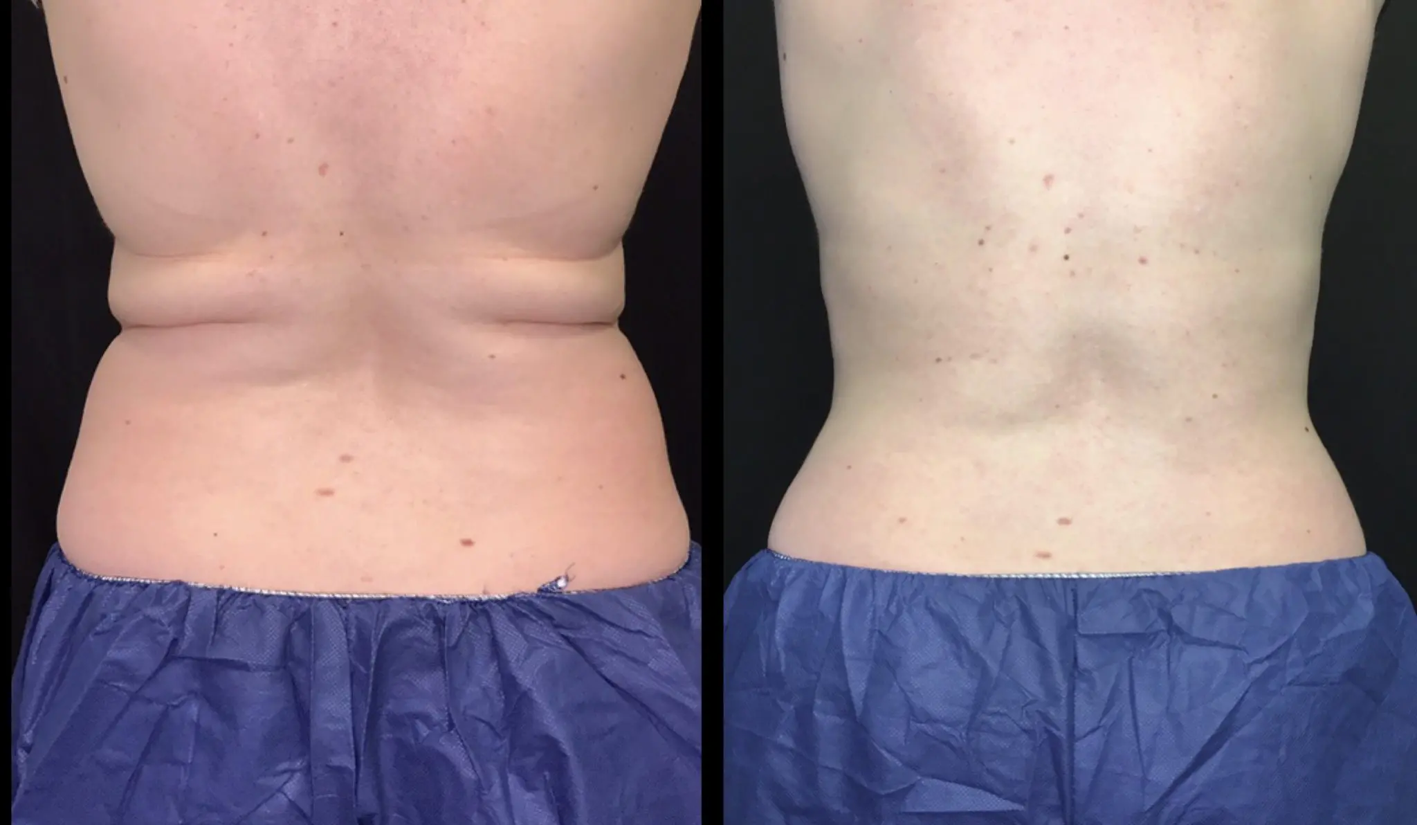 Coolsculpting on the back fat.