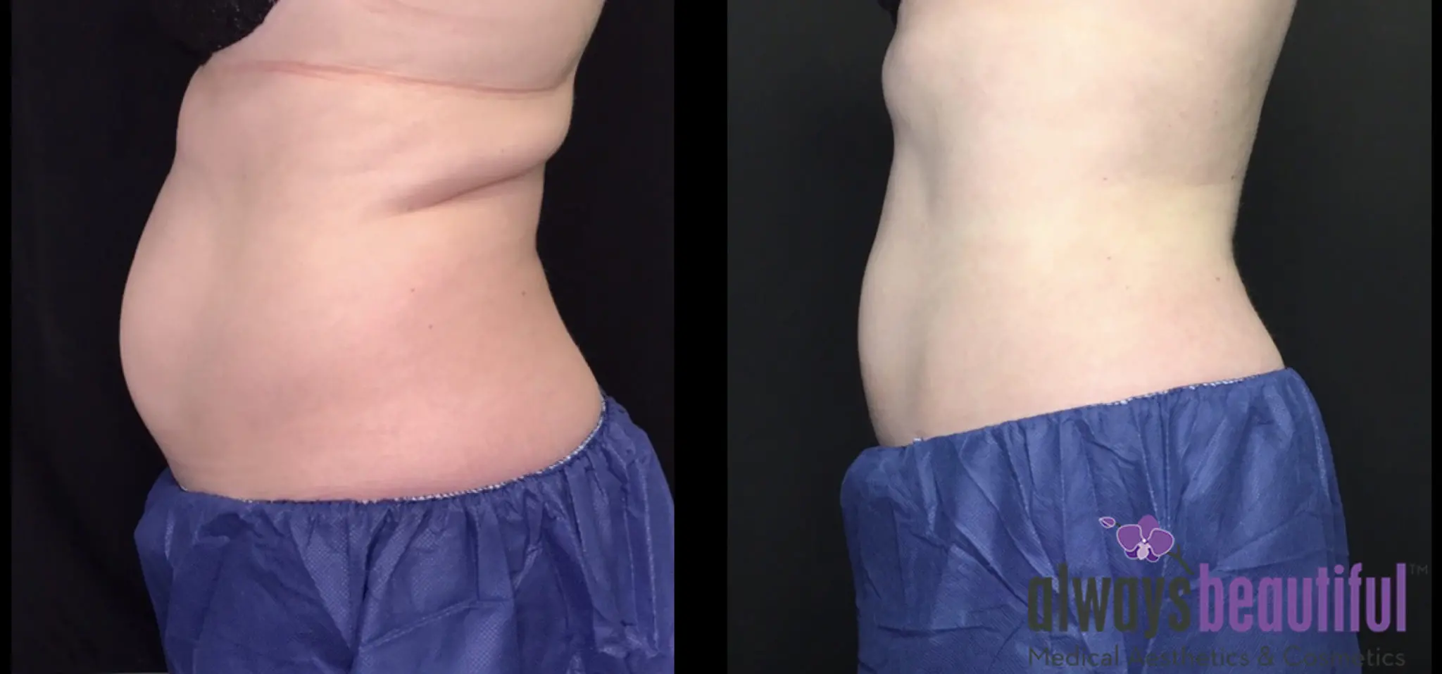 Coolsculpting on the abdomen.