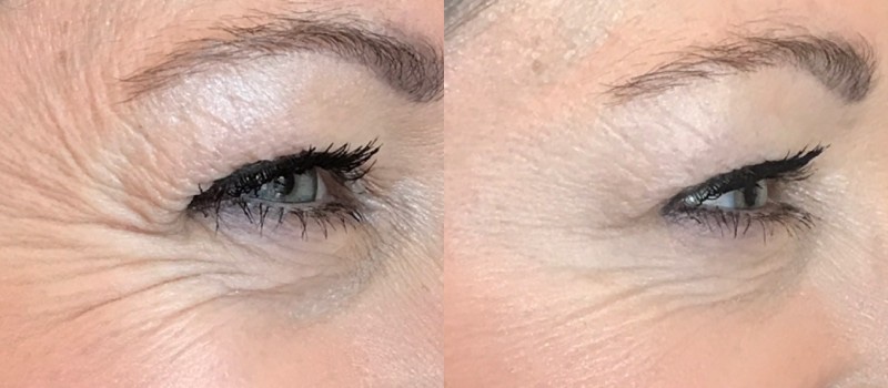 Womans forehead before and after Botox treatment at always beautiful, Denver CO