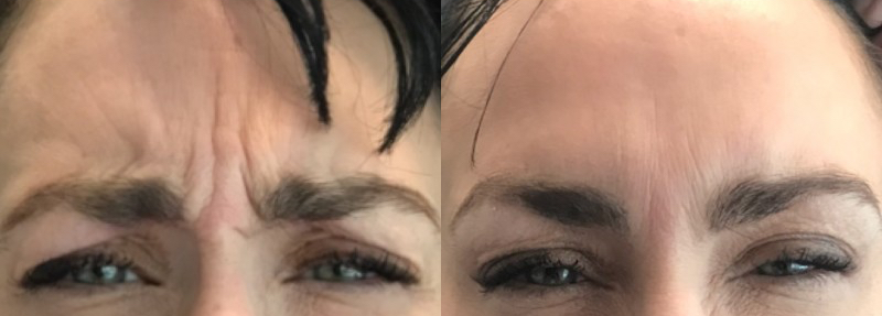 Womans forehead before and after Botox treatment at always beautiful, Denver CO