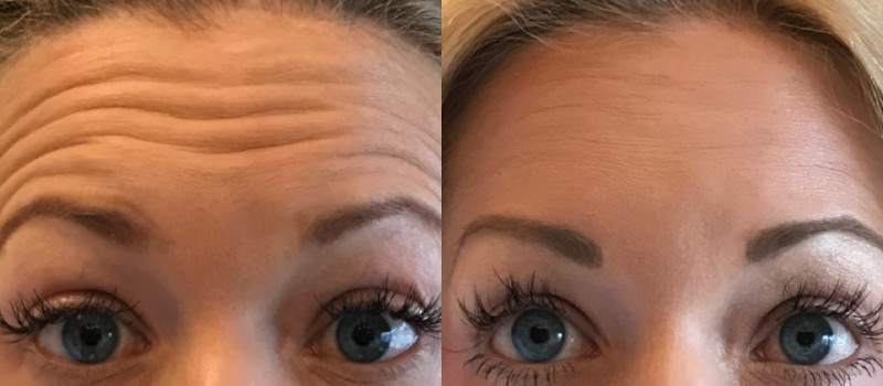 Womans forehead before and after Botox treatment at always beautiful, Denver CO