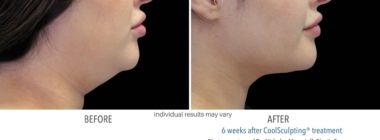 coolsculpting before and after chin fat