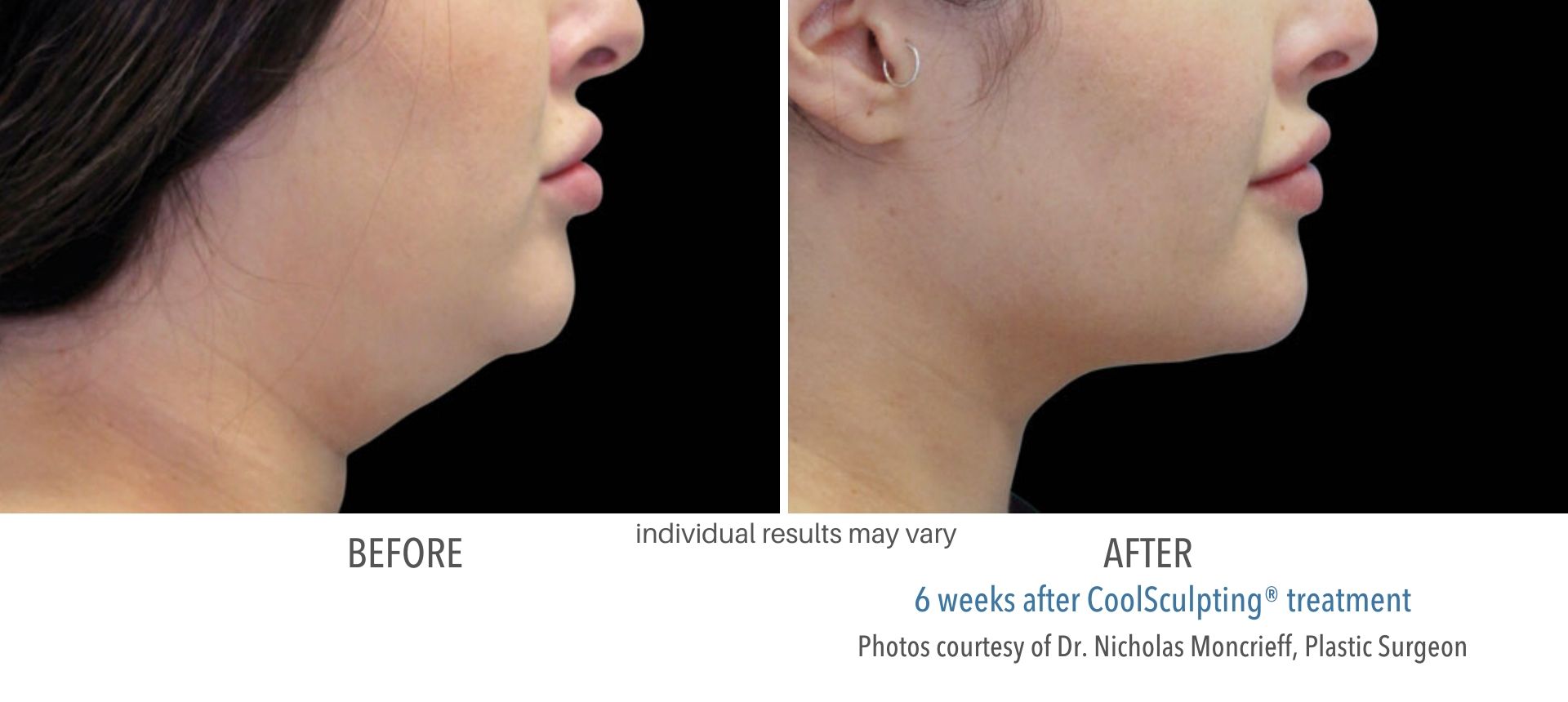 coolsculpting before and after chin fat