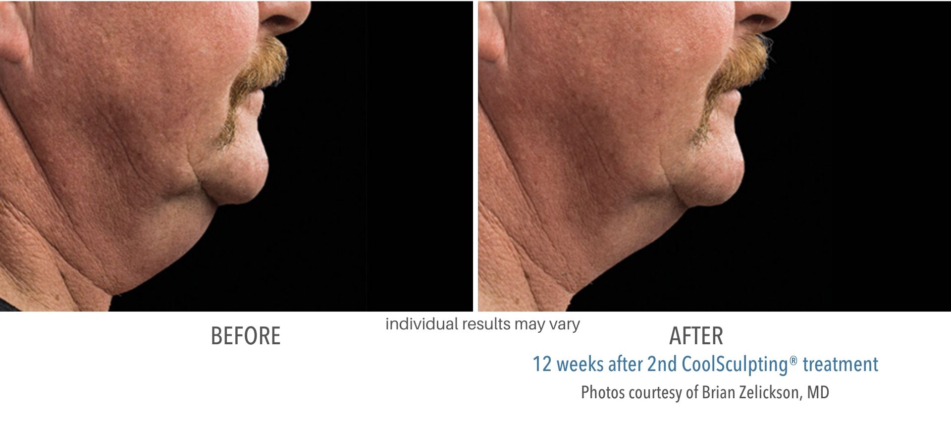 Coolsculpting Before and After Results From Actual Patients