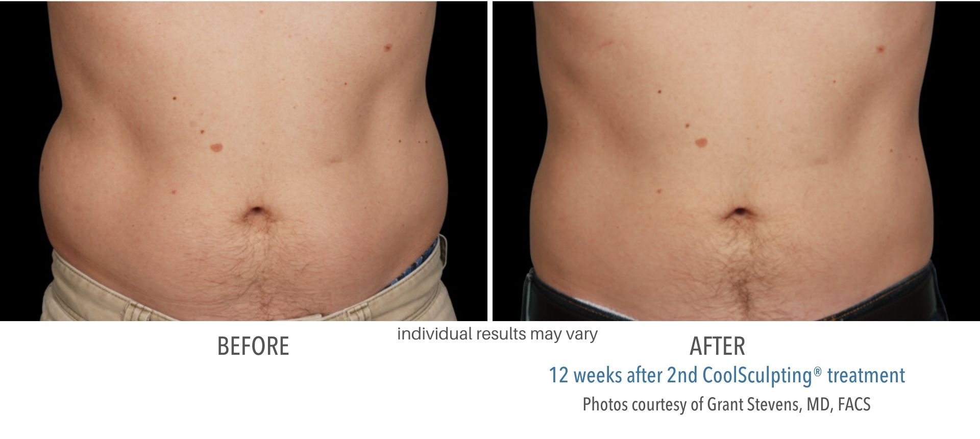 coolsculpting before and after abdomen male