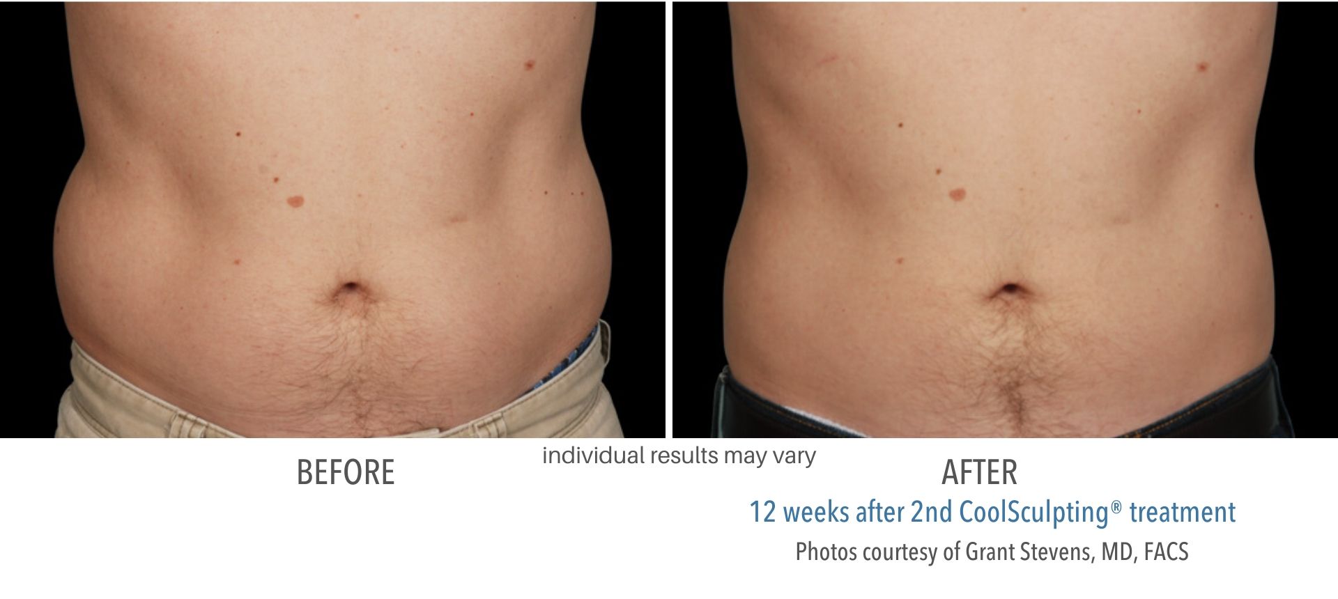 CoolSculpting Aurora CO | CoolSculpting in Denver