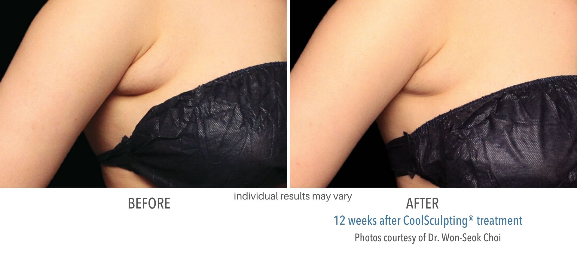 CoolSculpting In Aurora and Denver