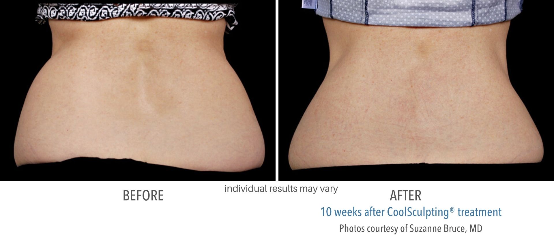 CoolSculpting In Aurora and Denver