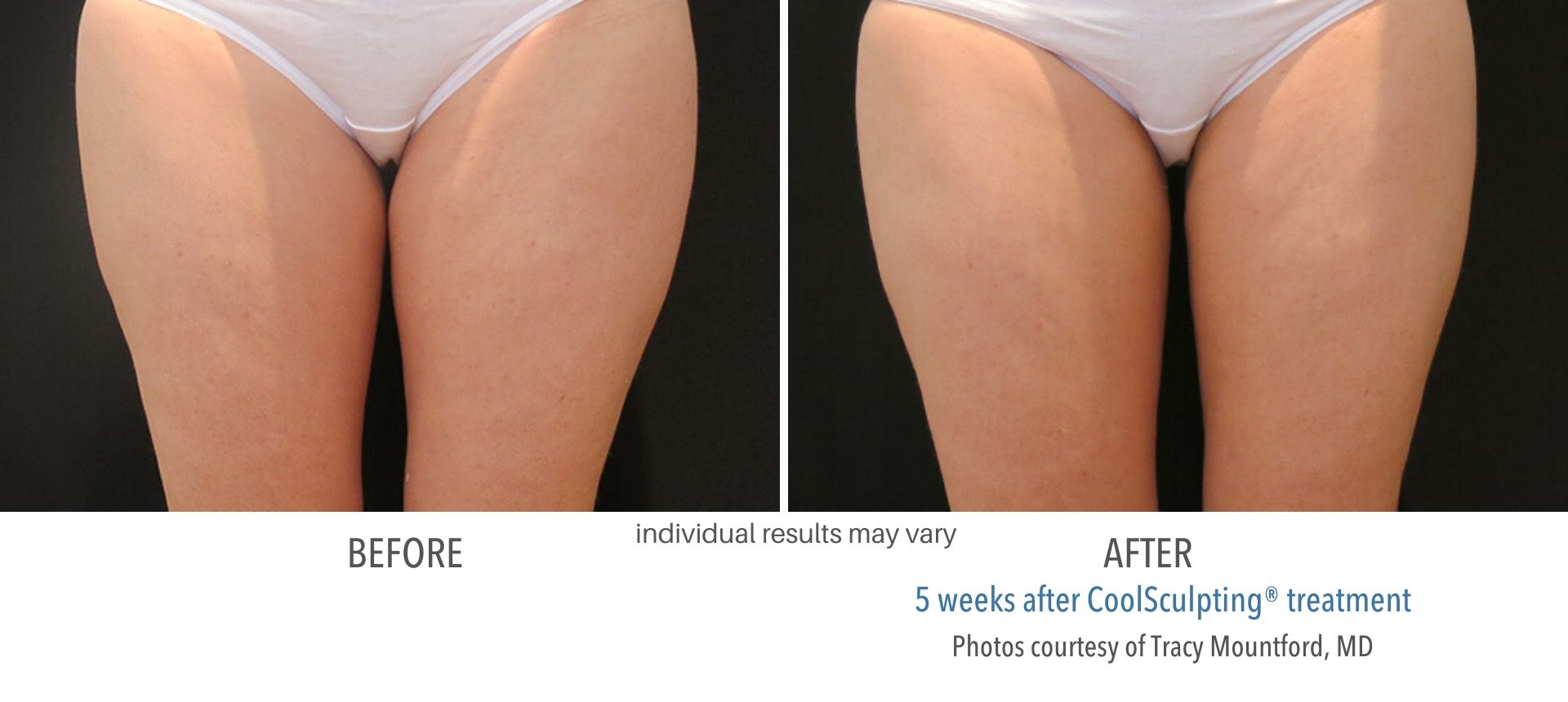 CoolSculpting In Aurora and Denver