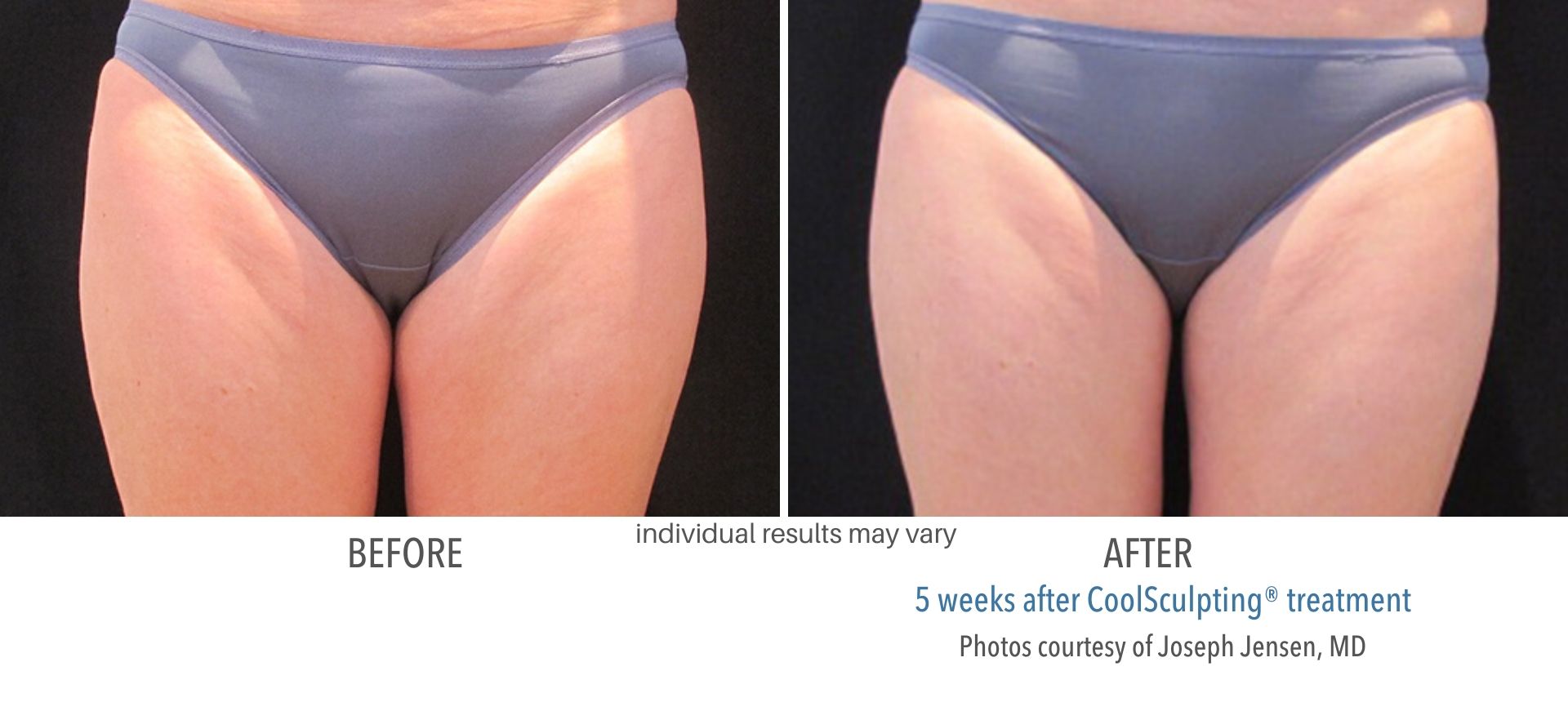 coolsculpting before and after inner thighs