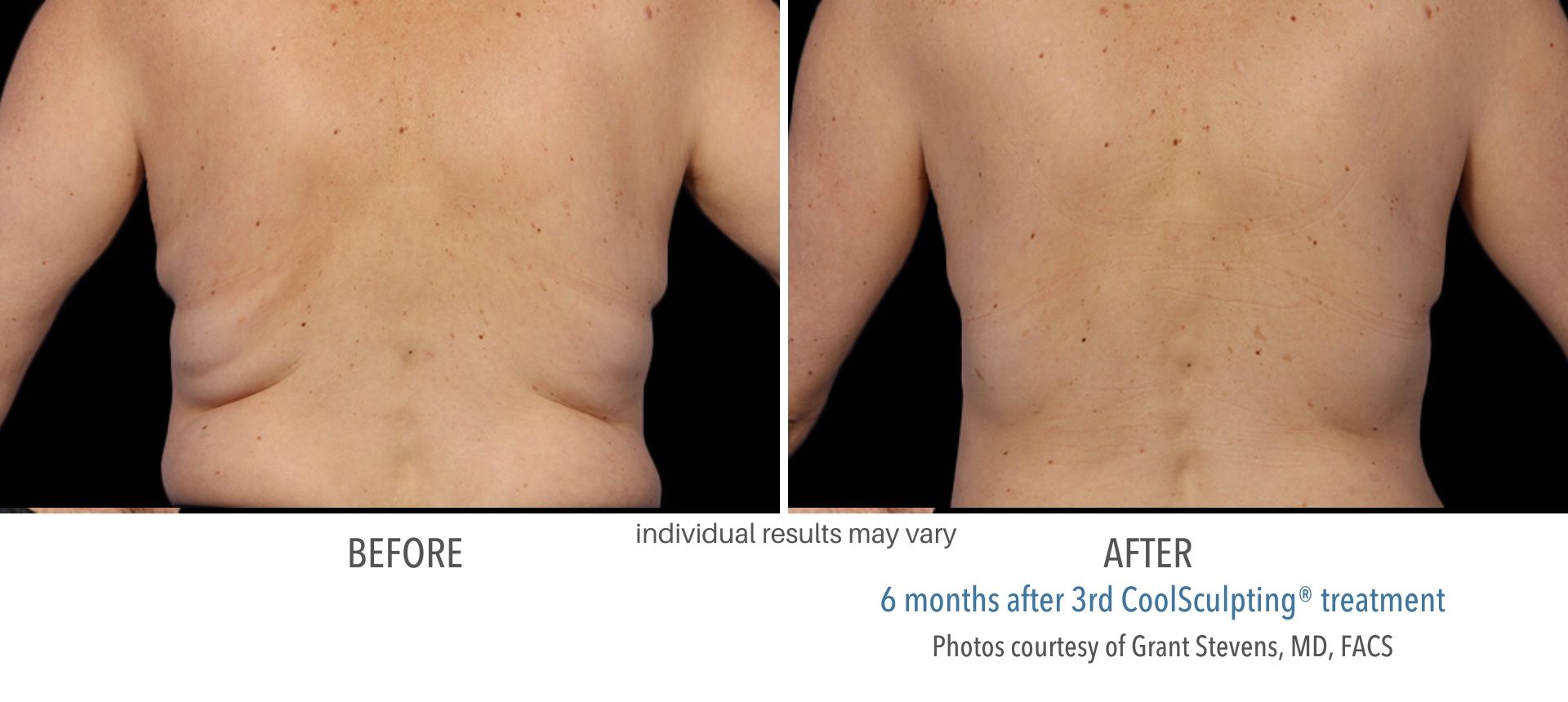 CoolSculpting In Aurora and Denver