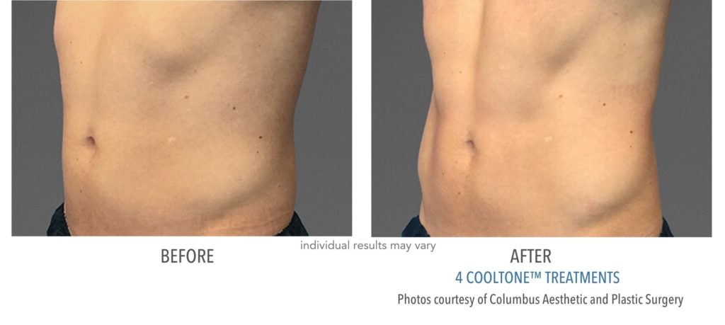 cooltone before and after at Always Beautiful Medspa in Aurora, CO