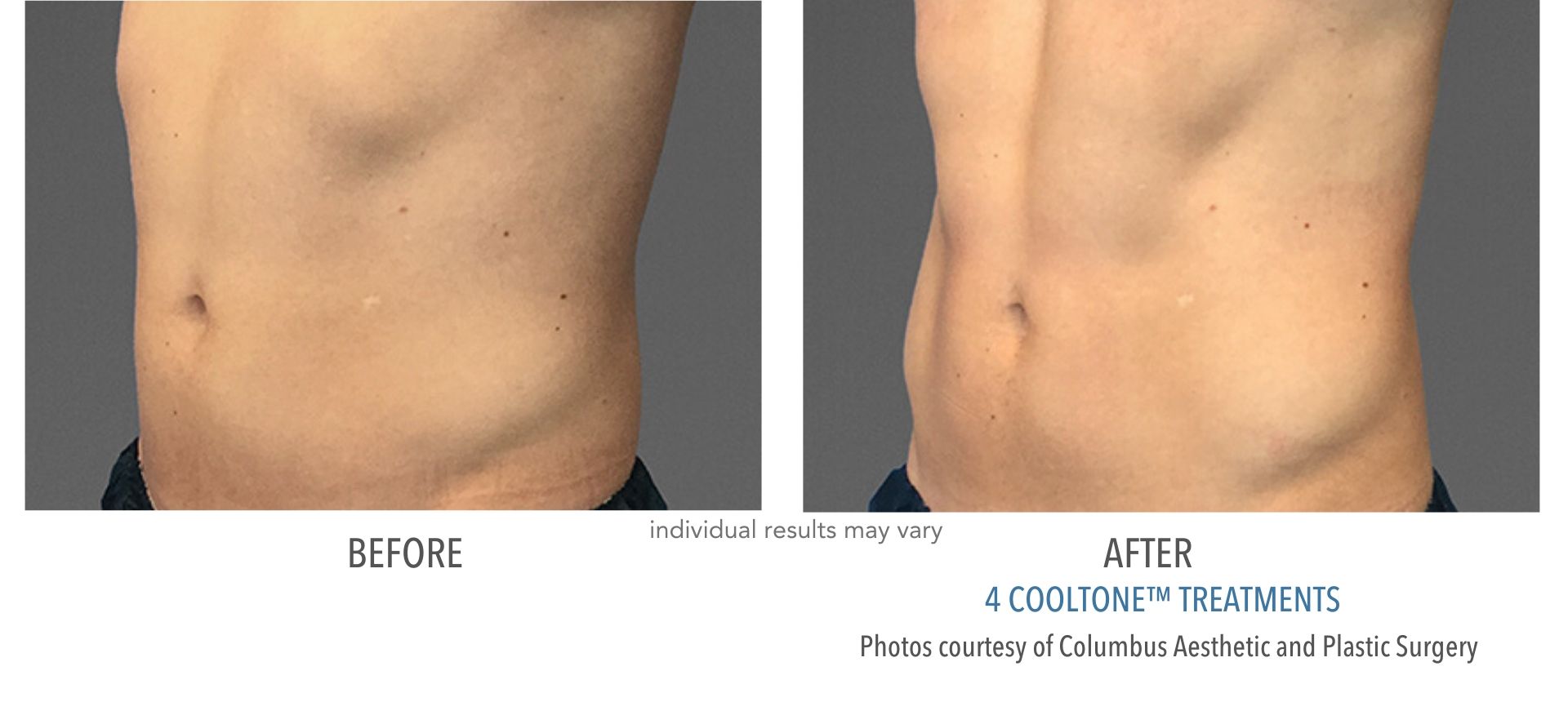 CoolSculpting In Aurora and Denver