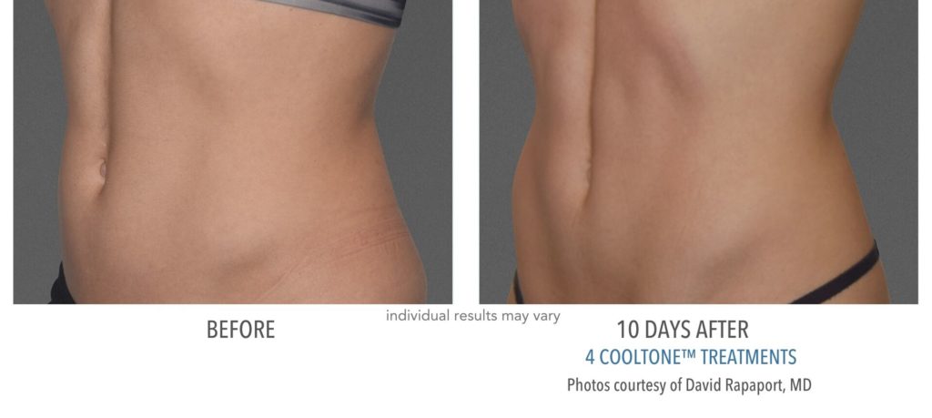 cooltone before and after female abdomen at Always Beautiful Medspa in Aurora, CO