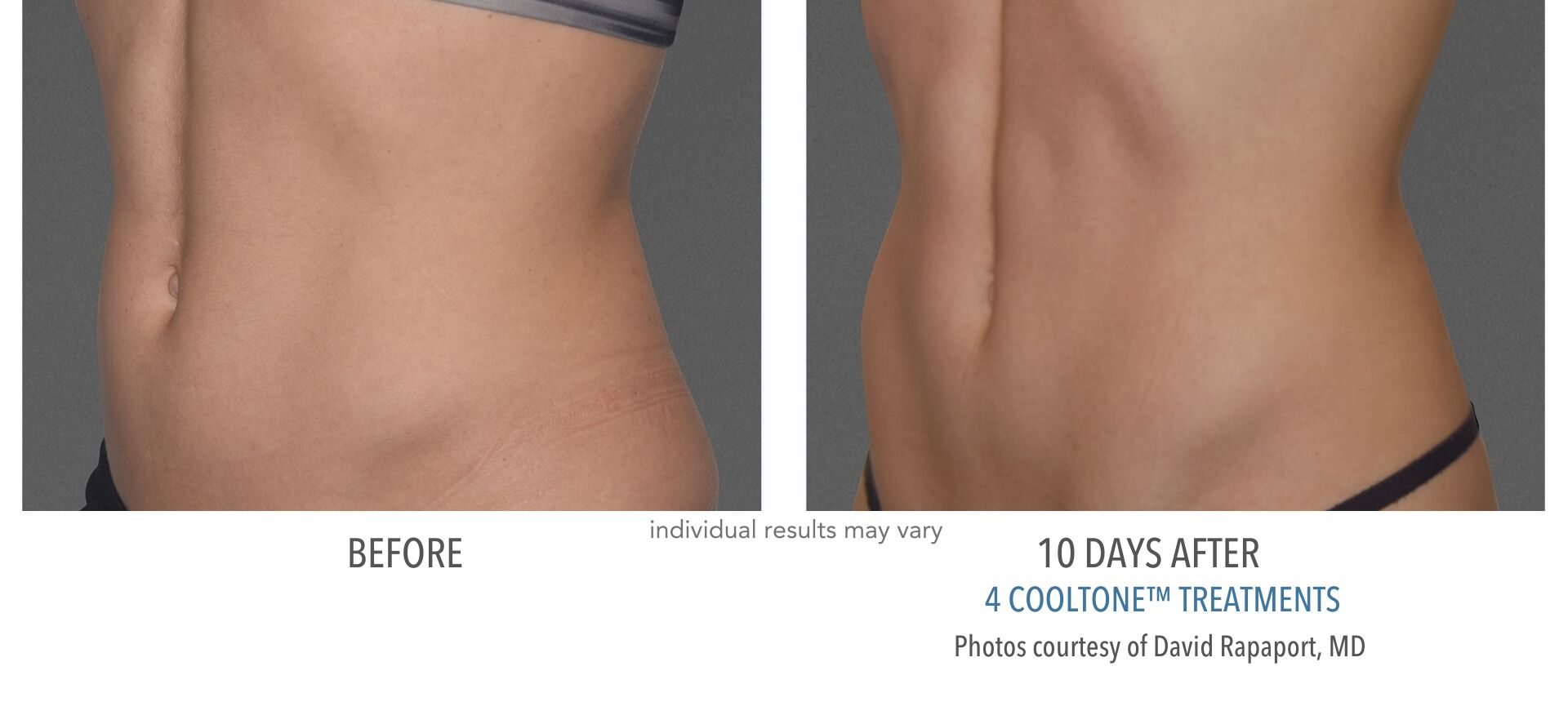 CoolSculpting In Aurora and Denver