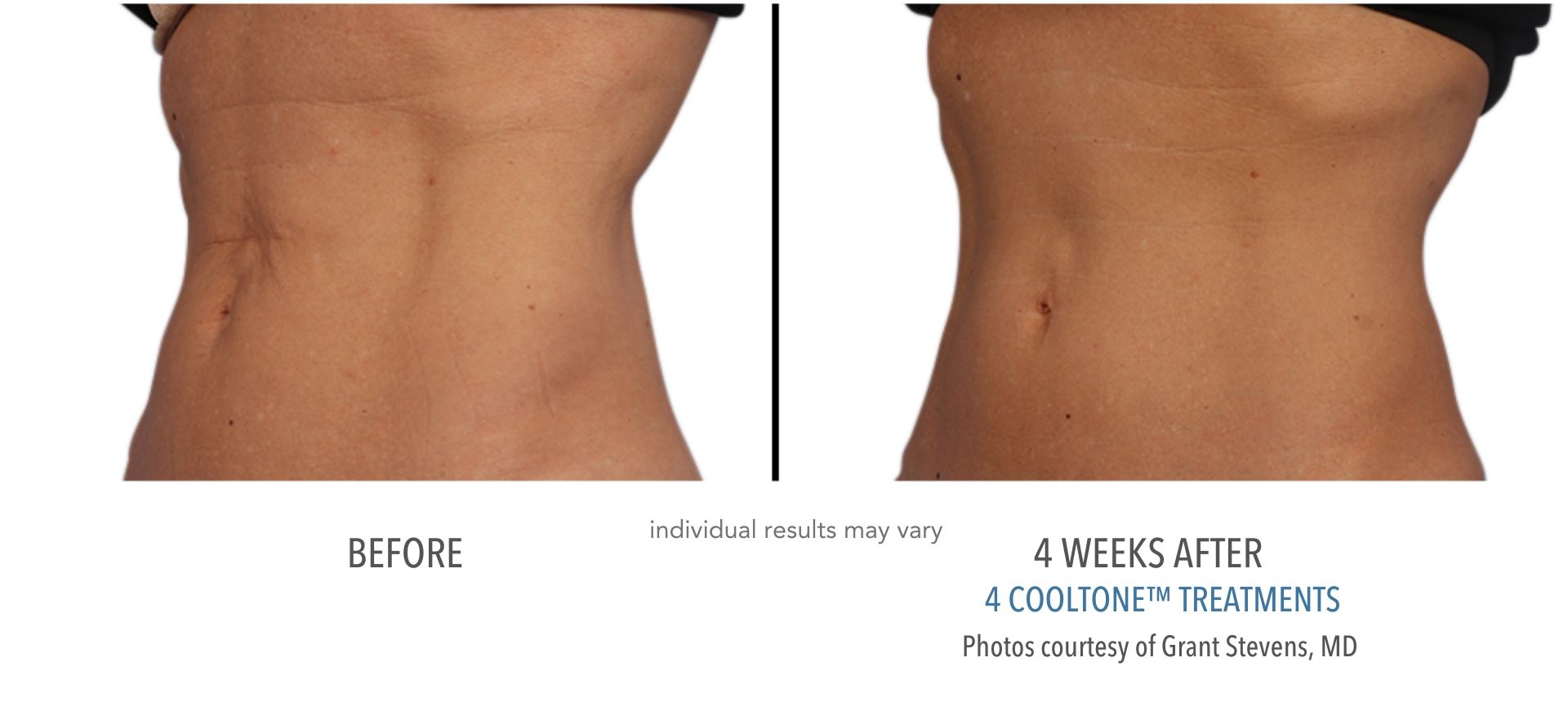 CoolSculpting In Aurora and Denver