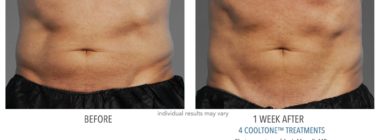cooltone before and after male abdomen at Always Beautiful Medspa in Aurora, CO
