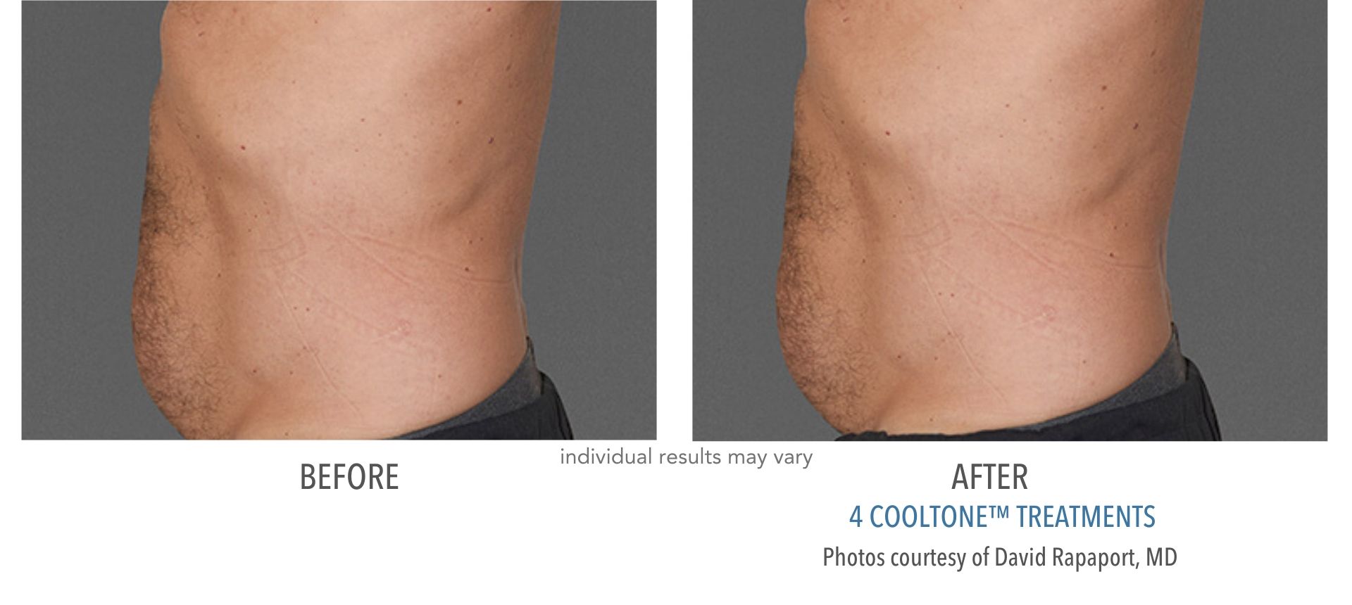 CoolSculpting In Aurora and Denver