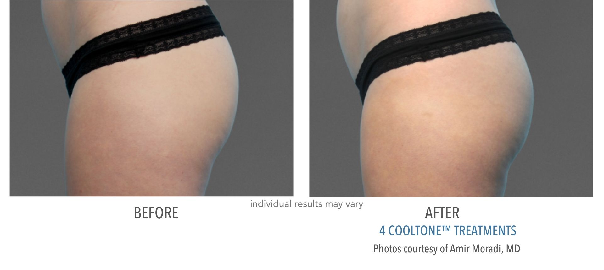 cooltone before and after buttocks at Always Beautiful Medspa in Aurora, CO