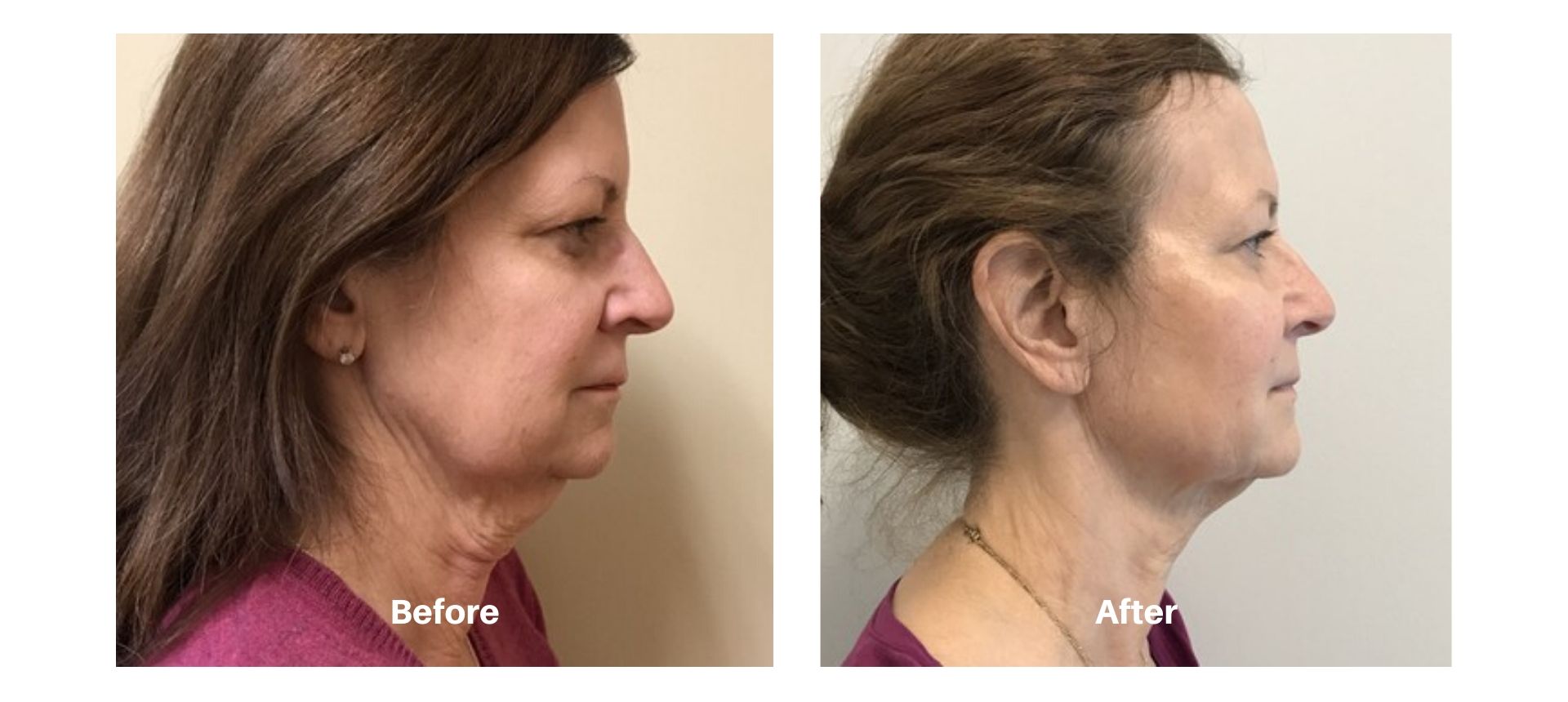 Woman's before and after pics from Kybella treatment at Always Beautiful.