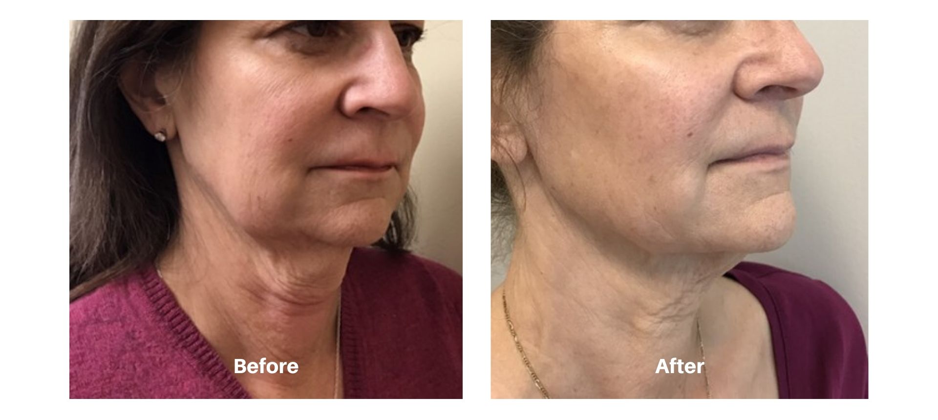 Woman's before and after treatment results from kybella to double chin at Always Beautiful.