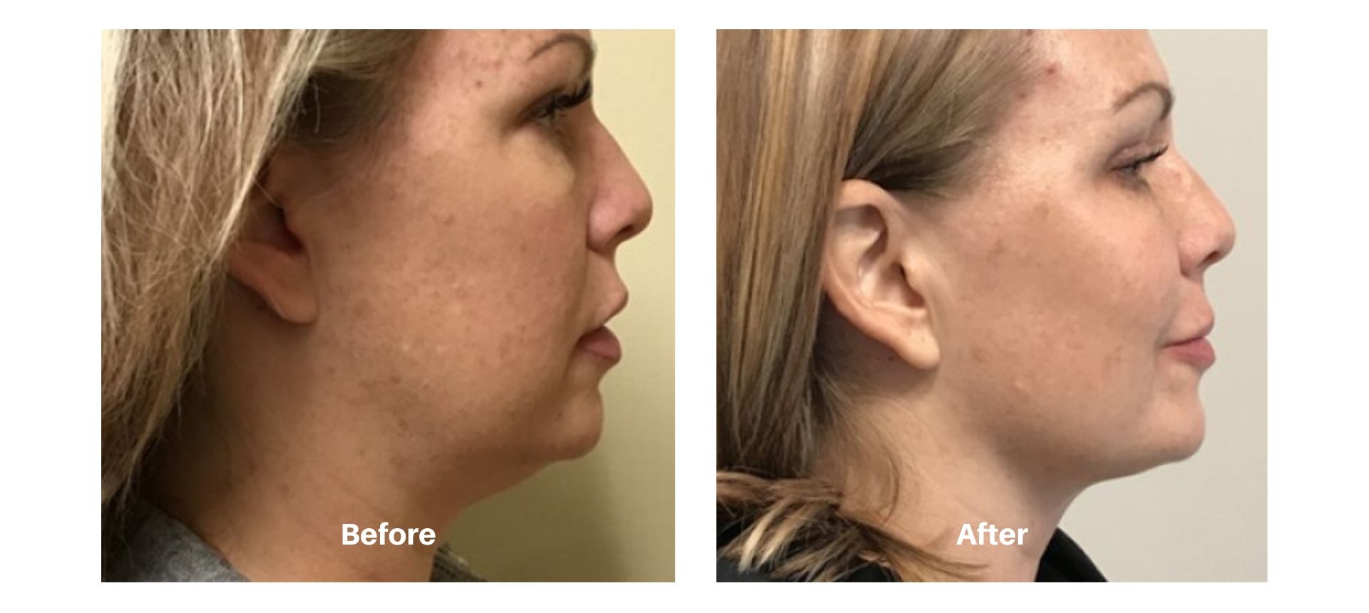 Woman's before and after images from kybella treatment at Always Beautiful.
