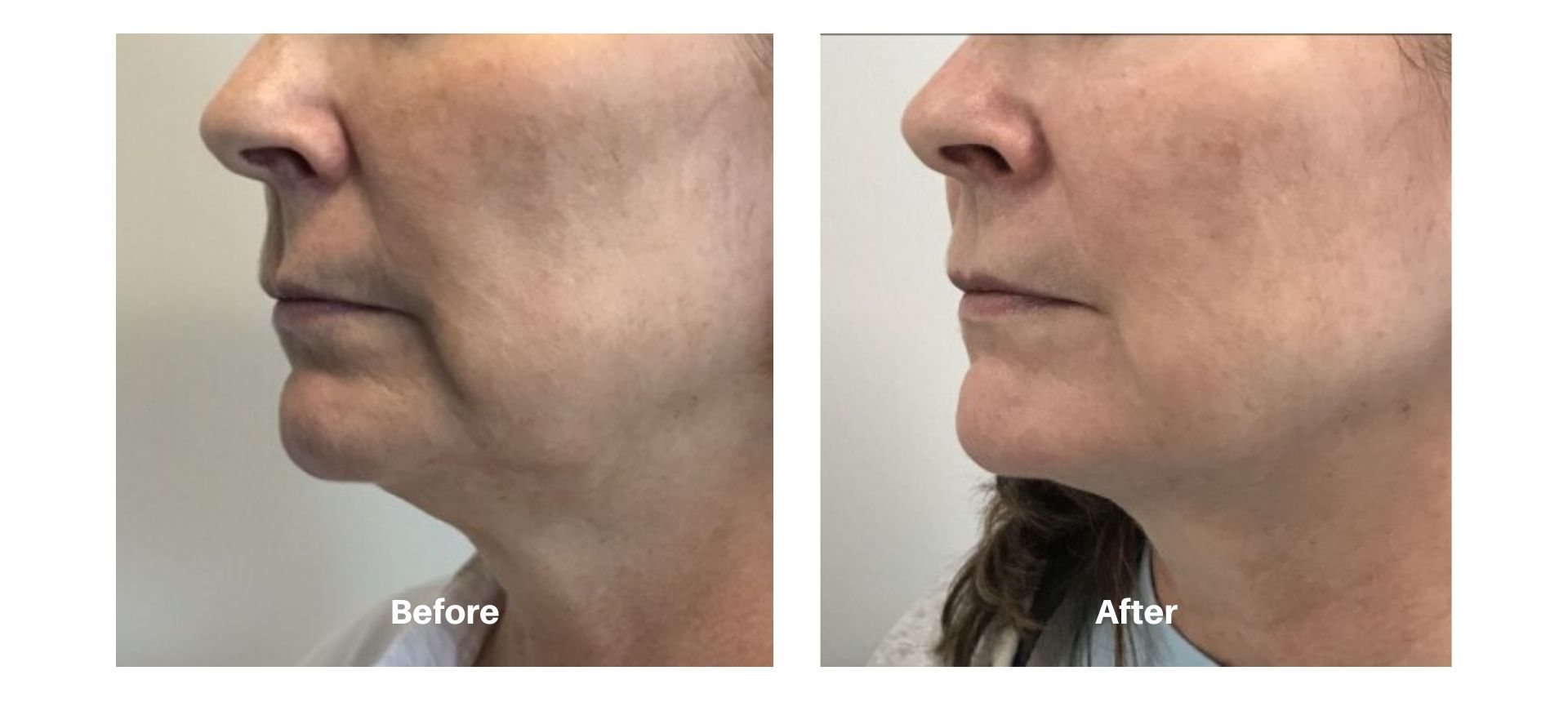 Woman's before and after results from kybella treatment at Always Beautiful.