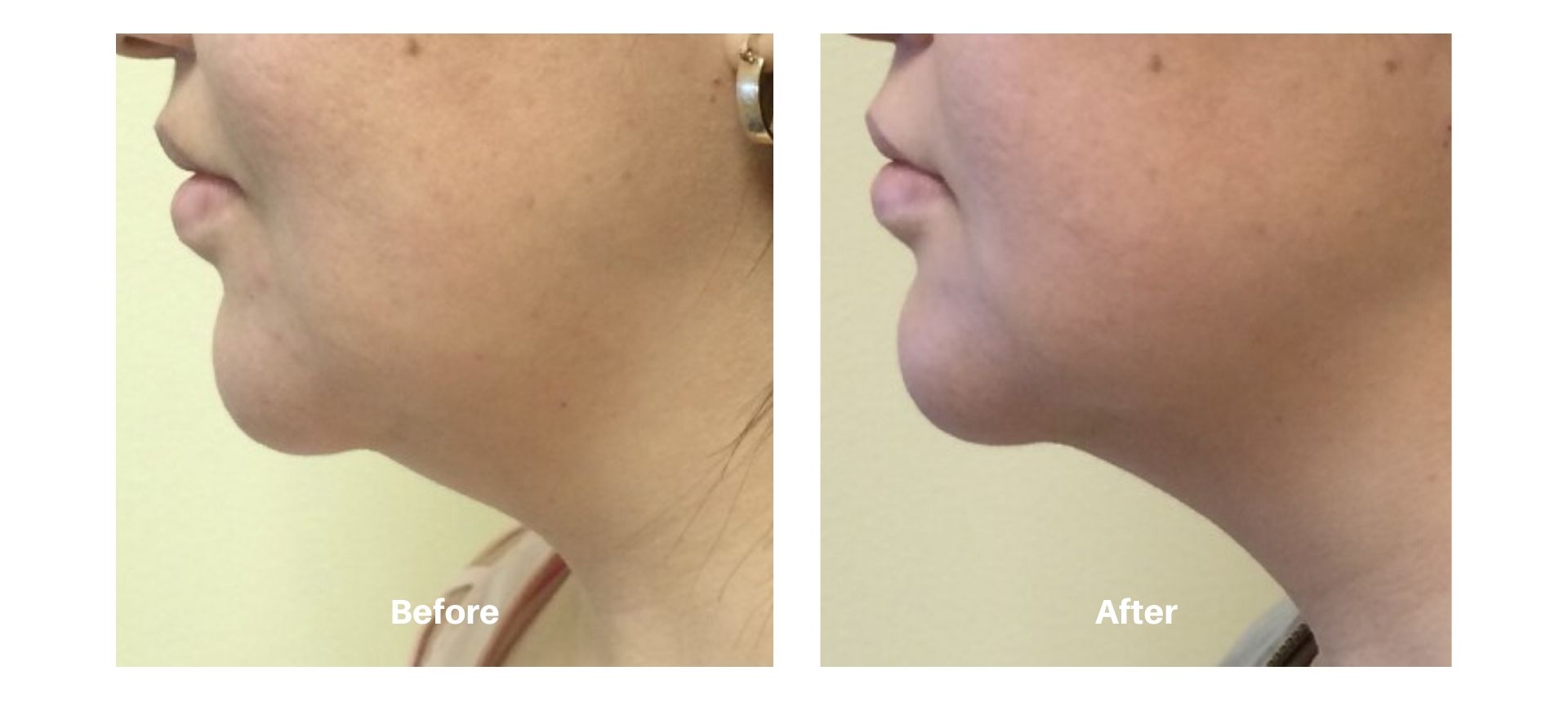 Woman's before and after results from kybella treatment at Always Beautiful.