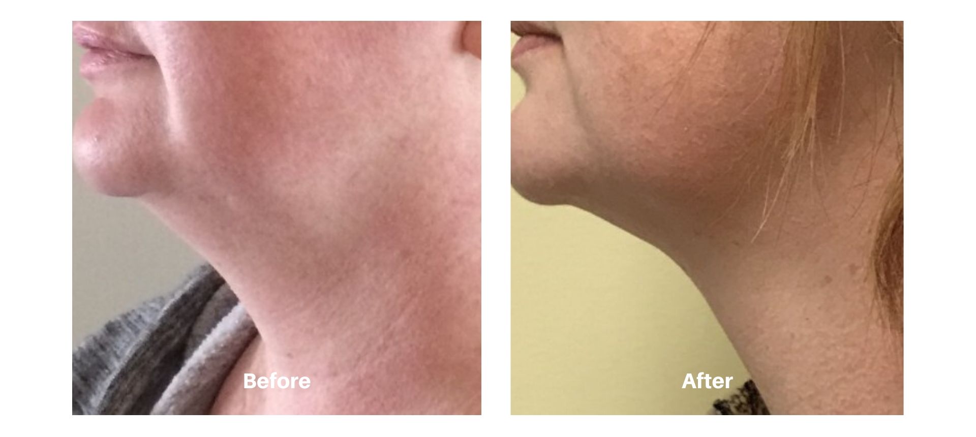 Woman's before and after pictures from Kybella treatment at Always Beautiful.