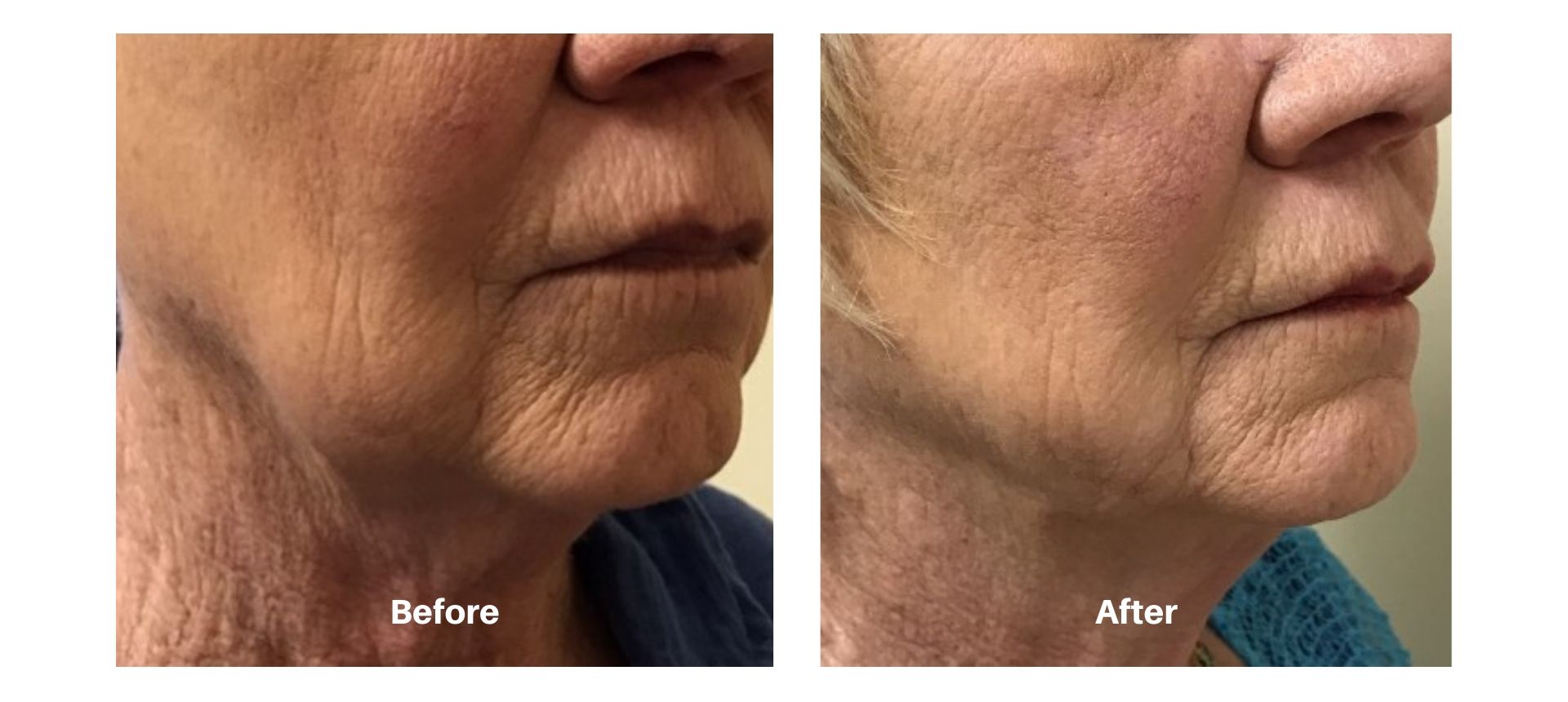 Woman's before and after pictures from kybella treatment at Always Beautiful.