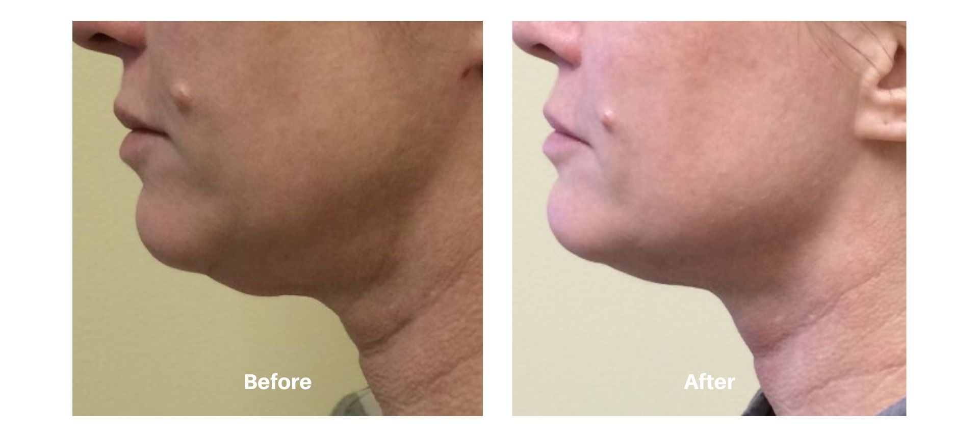 woman's before and after images from Kybella treatment at Always Beautiful.