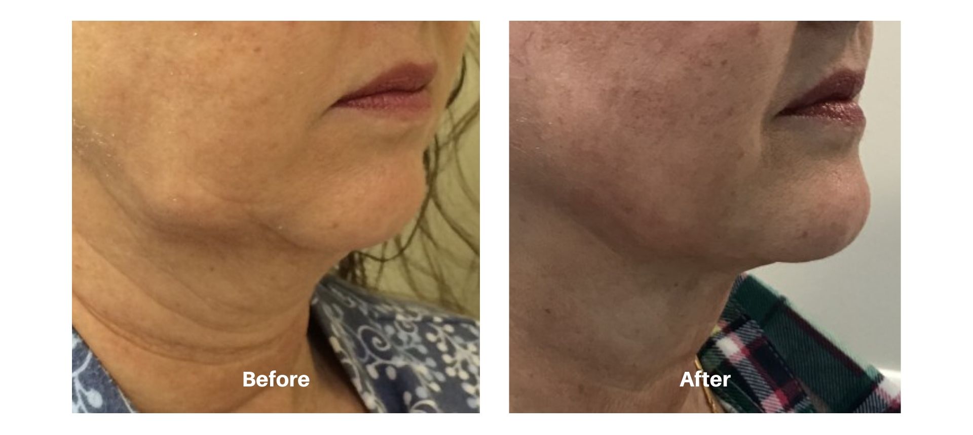 Woman's before and after images from kybella treatment at Always Beautiful in Aurora, Colorado.