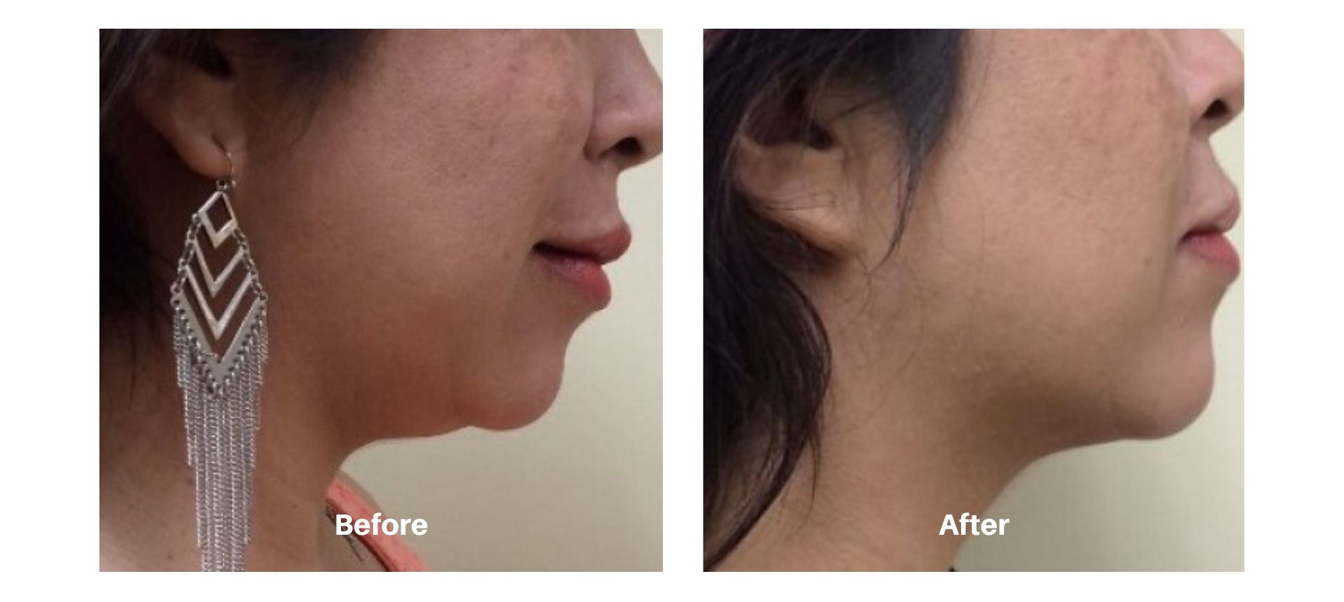 Woman's before and after images from Kybella treatment at Always Beautiful.