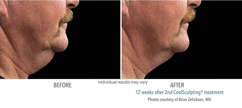 Man's before and after results to chin area from CoolSculpting treatment at Always Beautiful.