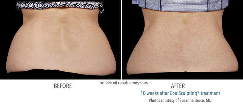Woman's before and after results to lower back flanks from CoolSculpting treatment done at Always Beautiful. 
