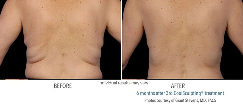 Man's before and after results to back from CoolSculpting treatments at Always Beautiful.