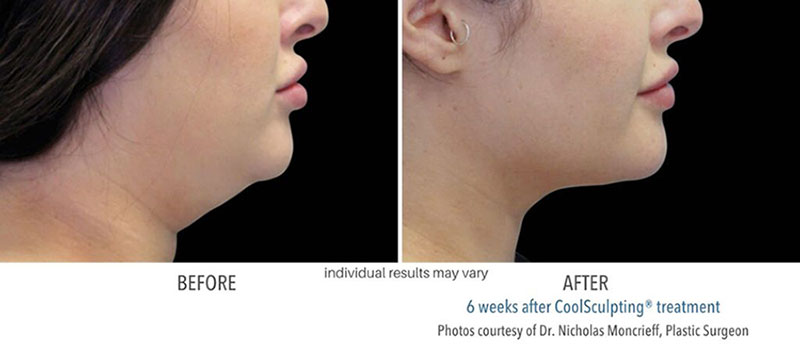 Womans CoolSculpting treatment results treating the chin showing before and after treatment with Always Beautiful. 