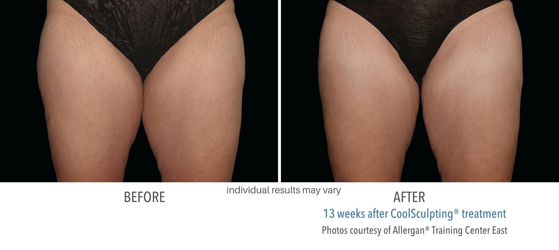 CoolSculpting treatment in thigh area