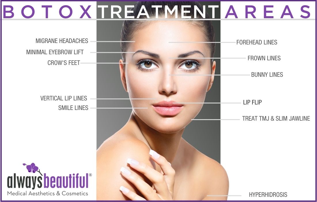 An image of a woman's face with labels for Botox treatment areas. Always Beautiful, Denver CO.