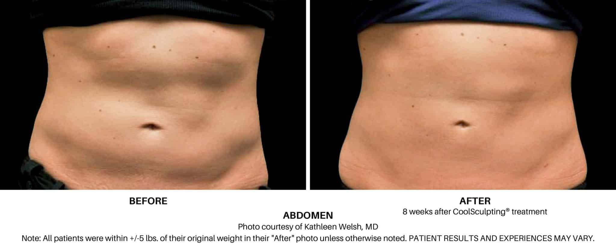 female coolsculpting abdomen before and after 01